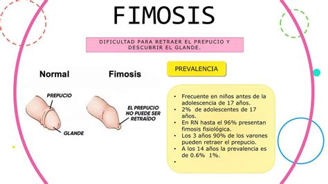 fimosis imagenes|Los 5 Tipos de Fimosis